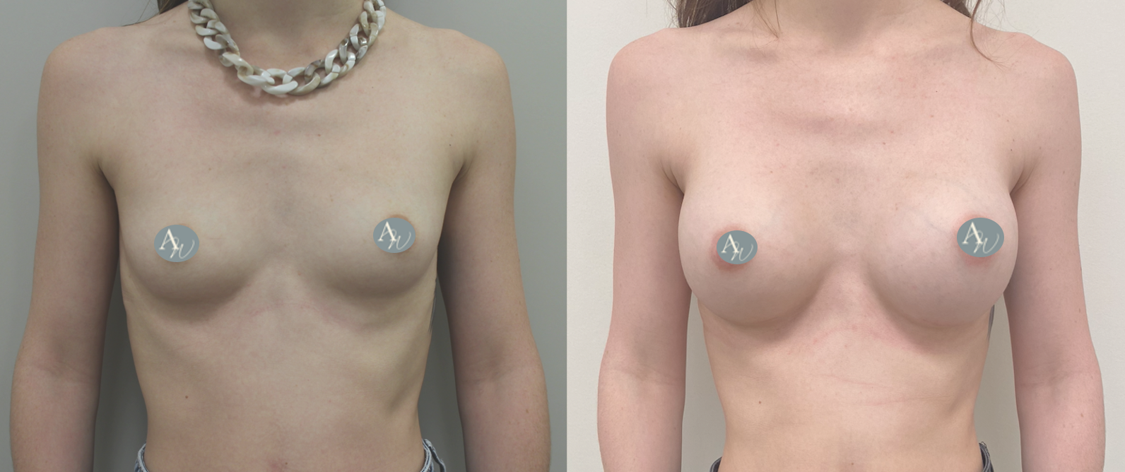 Avant/Après prothèses mammaires